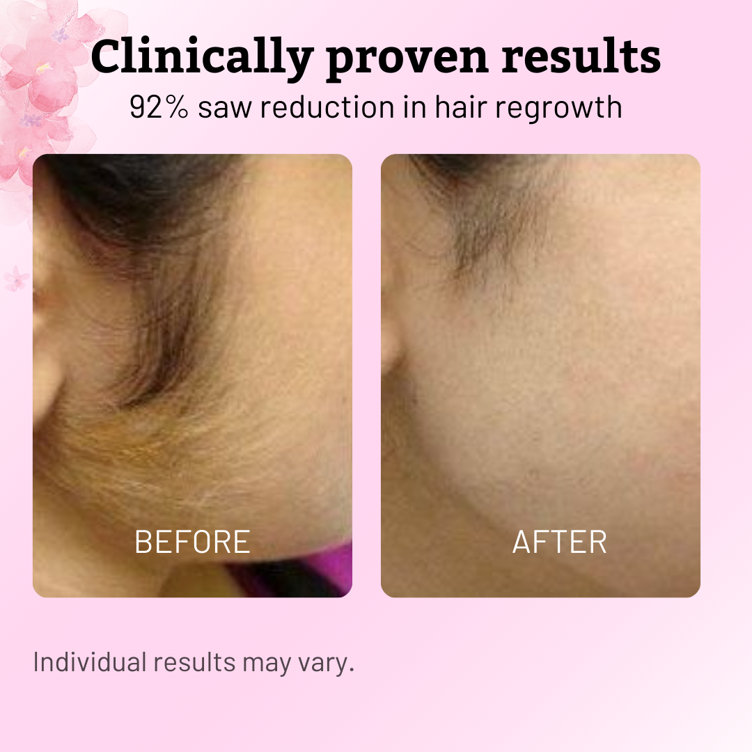 Cyperus Rotundus Oil for Hair Reduction(2-Pack)